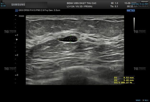 Hình ảnh siêu âm tuyến vú của bệnh nhân NTH