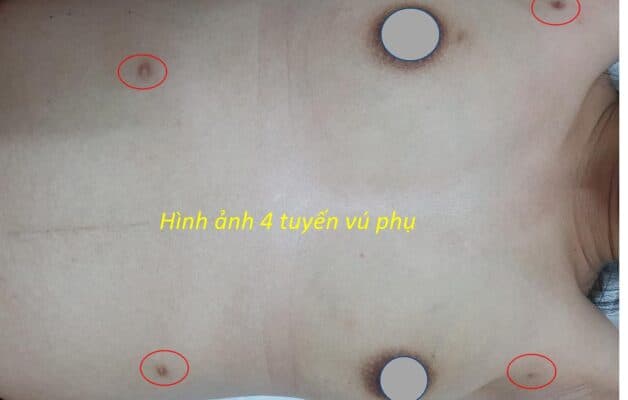 Hình ảnh tuyến vú phụ