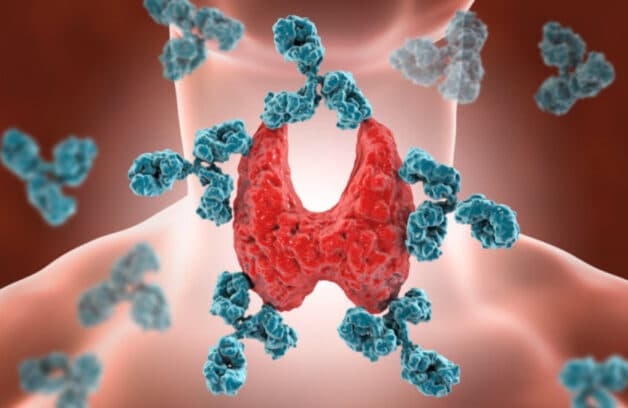 Viêm tuyến giáp tự miễn