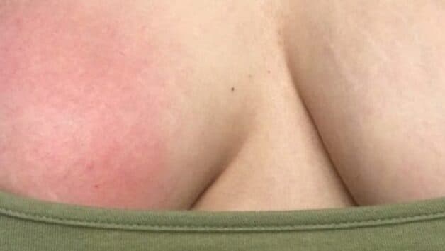 Viêm tuyến vú có nguy hiểm không là thắc mắc chung của nhiều người