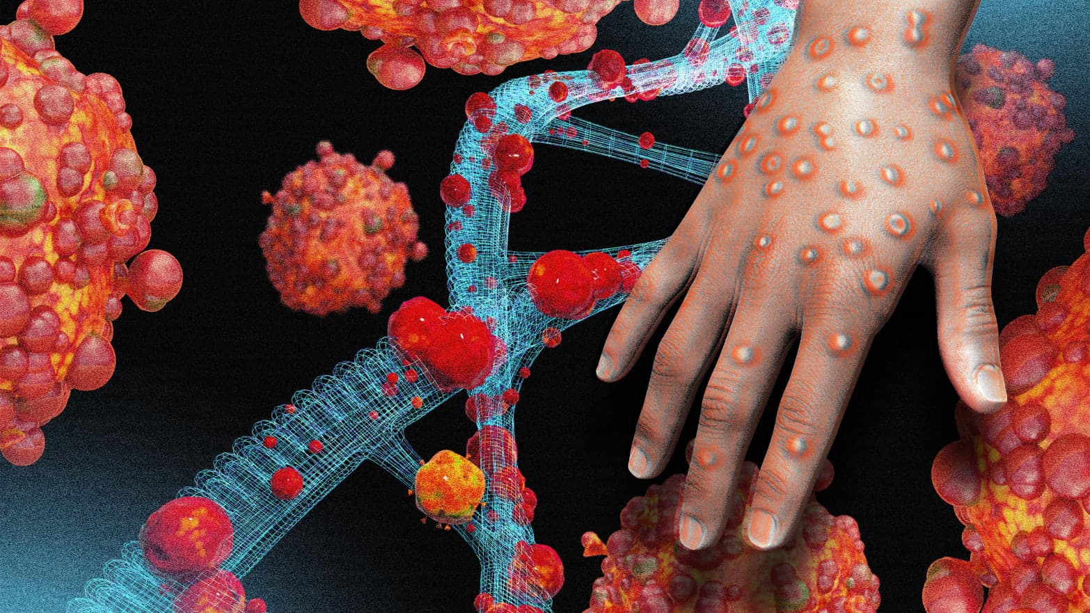 Theo các thống kê dịch tễ, bất cứ ai đều có khả năng mắc bệnh đậu mùa khỉ