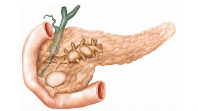 Thông tin cần biết cho những người bị viêm tụy