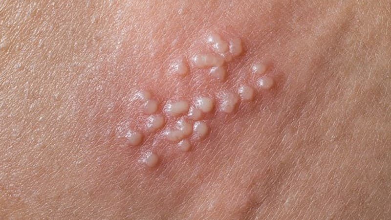 Bệnh lậu ở nữ giới thường không có dấu hiệu nhận biết