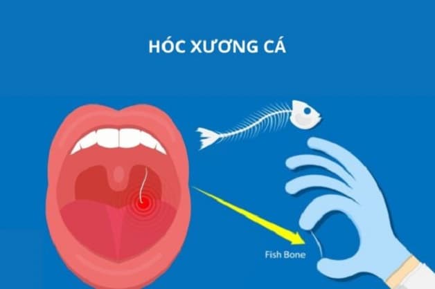 cách chữa hóc xương cá nhanh nhất