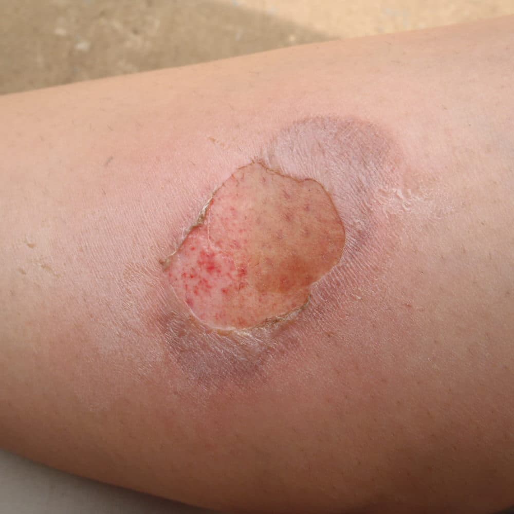 Tất cả các loại vết thương hở, trầy xước hoặc rách da,... đều tạo điều kiện thuận lợi cho vi khuẩn uốn ván xâm nhập vào cơ thể và gây ra bệnh