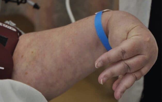 Co cứng sau đột quỵ