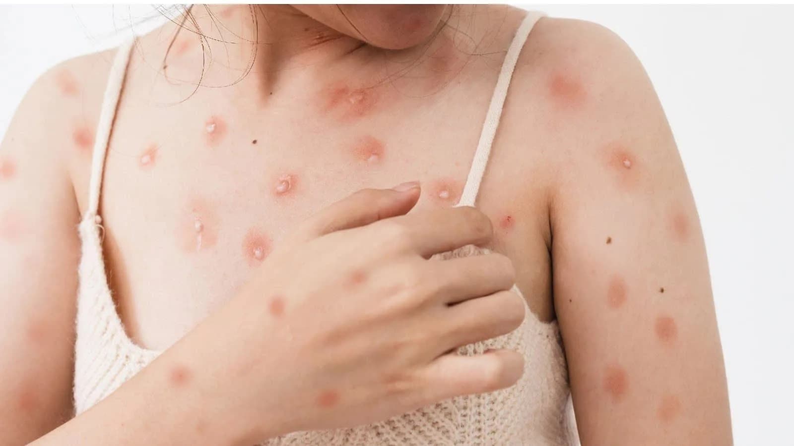 Mẹ bầu nên thông báo cho bác sĩ sản khoa hoặc bác sĩ có chuyên môn dịch tễ về các dấu hiệu nghi ngờ dấu hiệu đậu mùa khỉ