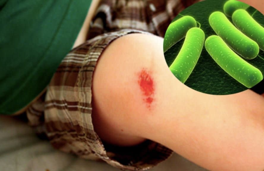 Phát hiện sớm các dấu hiệu uốn ván giúp việc điều trị trở nên thuận lợi hơn và mang lại khả năng khỏi bệnh cao hơn cho người bệnh