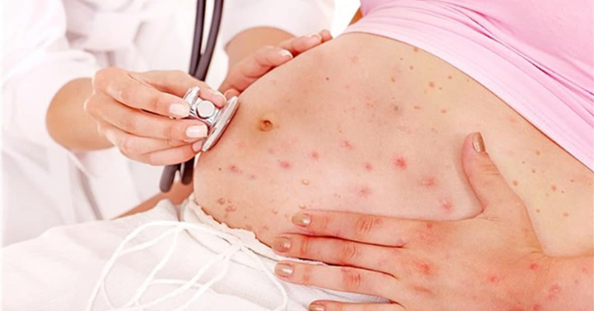 Bệnh đậu mùa khỉ ảnh hưởng đến thai nhi không là điều khiến nhiều mẹ lo lắng trước tình hình dịch bệnh diễn biến phức tạp