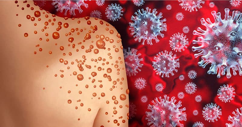 Đậu mùa khỉ xuất hiện ở Việt Nam dấy lên sự quan tâm về căn bệnh đậu mùa khỉ là bệnh gì