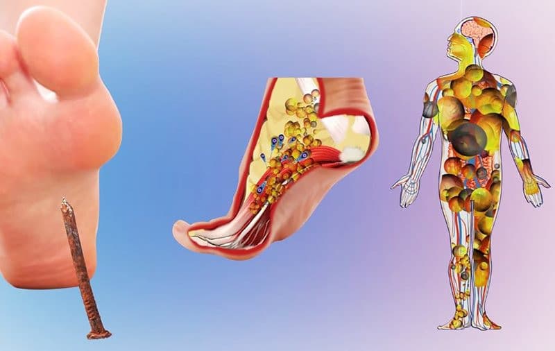 Uốn ván có thể gây ra những biến chứng ảnh hưởng nghiêm trọng đến sức khỏe, thậm chí là tính mạng con người nếu không tiêm chủng vắc xin đầy đủ