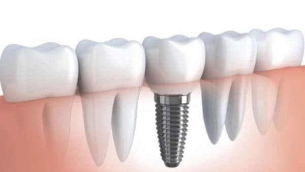 địa chỉ cấy ghép implant tốt