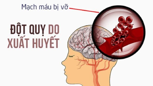 di chứng đột quỵ phổ biến