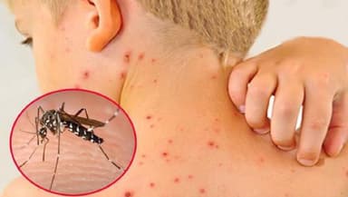 Đặc điểm giai đoạn 2 của sốt xuất huyết