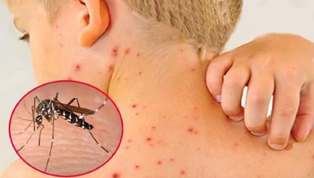 Đặc điểm giai đoạn 2 của sốt xuất huyết