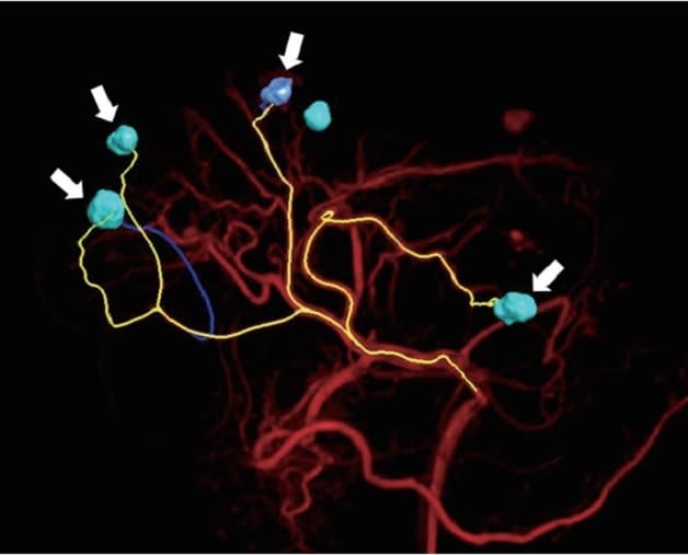 Phương pháp nút mạch trong điều trị bệnh ung thư gan
