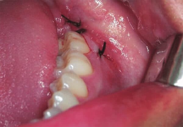 nhổ răng khôn quên cắt chỉ