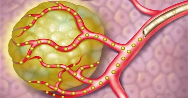 phương pháp nút mạch gan