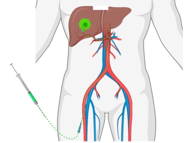 Phương pháp nút mạch trong điều trị bệnh ung thư gan
