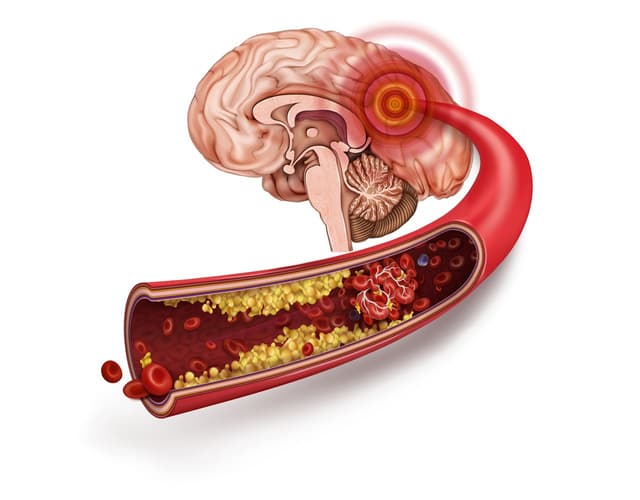 Cách phòng ngừa đột quỵ não do xơ vữa động mạch