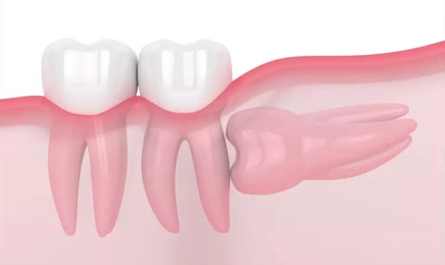Răng khôn mọc ngầm 90 độ và cách xử trí