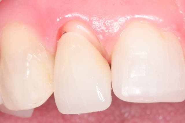 Những việc cần làm nếu răng sứ rớt ra