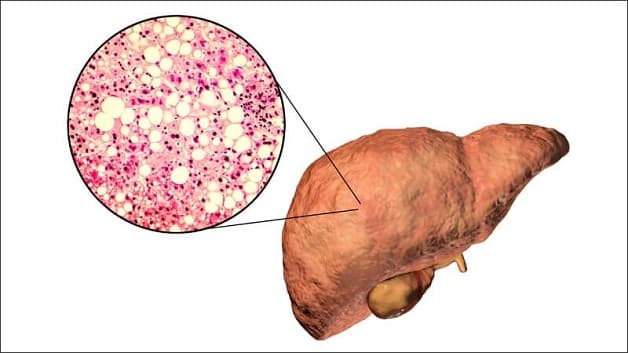 Rối loạn gan nhiễm mỡ là gì?