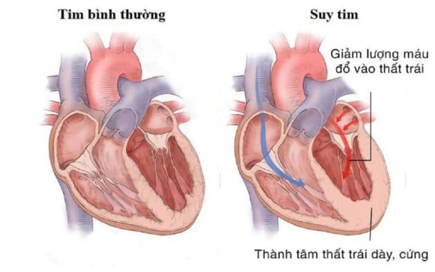 Hình ảnh so sánh sự khác biệt tim bình thường và suy tim