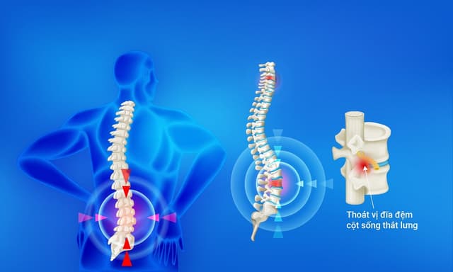 Lưu ý thoát vị đĩa đệm không nên tập gì?