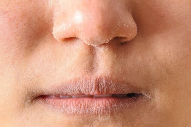 Da bị khô, tróc vảy là một trong những dấu hiệu .bệnh tuyến giáp đa nhân.