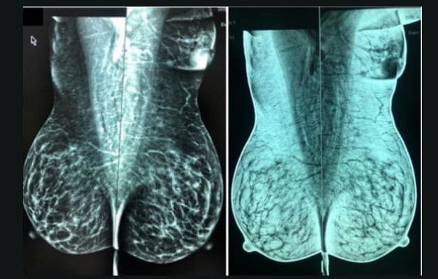 Hình ảnh tuyến vú lạc chỗ qua nhũ ảnh