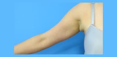 U tuyến vú phụ ở nách: Nguyên nhân, cách điều trị