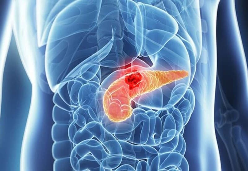 Tìm hiểu các thông tin về bệnh ung thư tụy