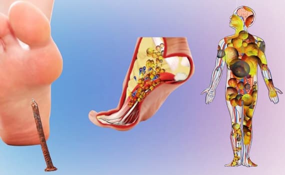 uốn ván tiêm mấy mũi