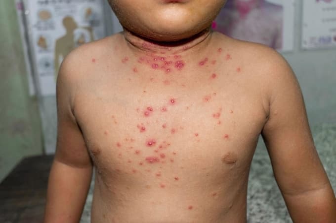 Bệnh đậu mùa khỉ hay còn có tên gọi khác là monkeypox, là bệnh truyền nhiễm gây ra do virus đậu mùa khỉ