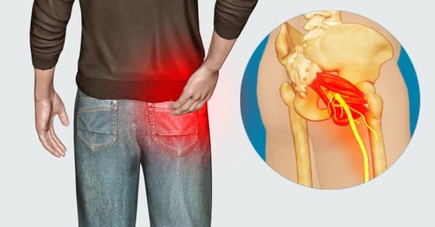 Đau dây thần kinh tọa là bệnh thường gặp.