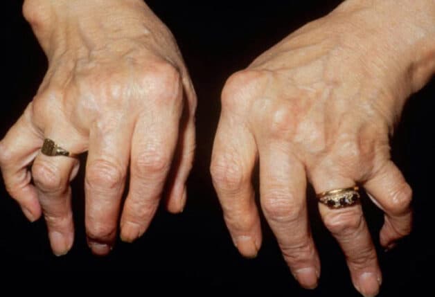 Viêm khớp dạng thấp chẩn đoán khó khăn vì triệu chứng ở giai đoạn đầu mờ nhạt