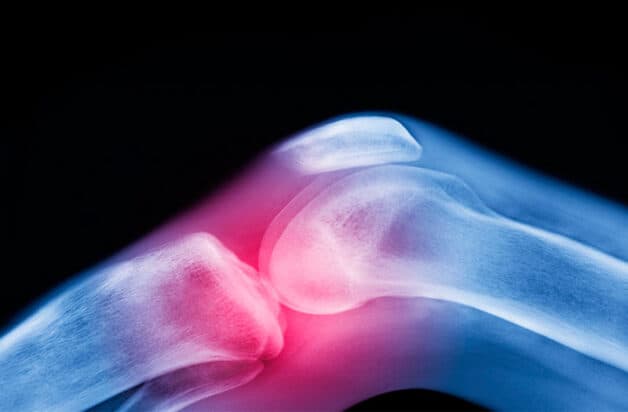 Bệnh viêm khớp nhiễm khuẩn thường xảy ra ở khớp gối, gây đau nhức, sưng đỏ