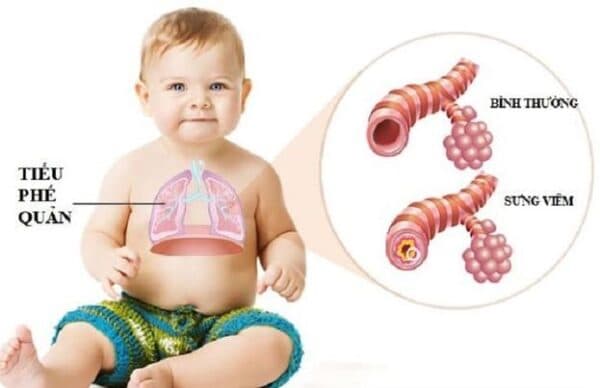 Viêm tiểu phế quản ở trẻ em: Cách điều trị an toàn, hiệu quả-1