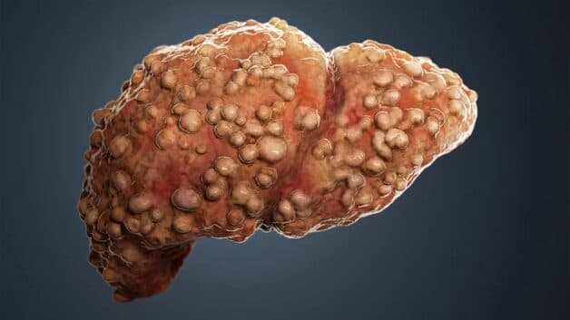 Tìm hiểu về tình trạng ung thư gan HCC trên nền xơ gan