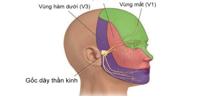 Nguyên nhân dẫn đến bệnh viêm dây thần kinh số 5