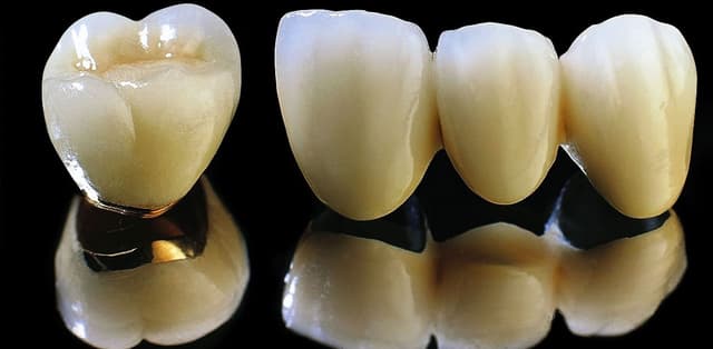 Câu hỏi số 1 trước khi làm răng sứ: 1 cái răng sứ bao nhiêu tiền