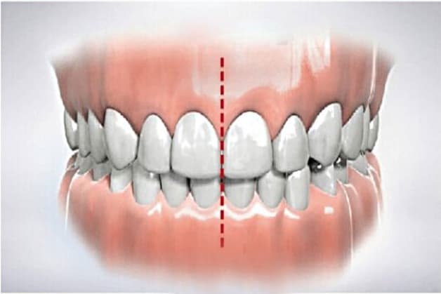 hàm răng khớp nhau