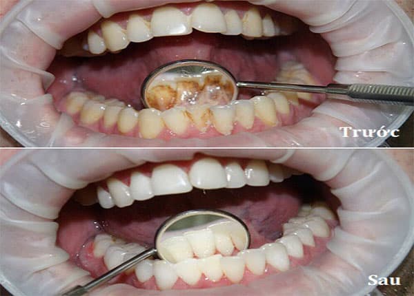 6 tháng cạo vôi răng 1 lần có thực sự tốt?