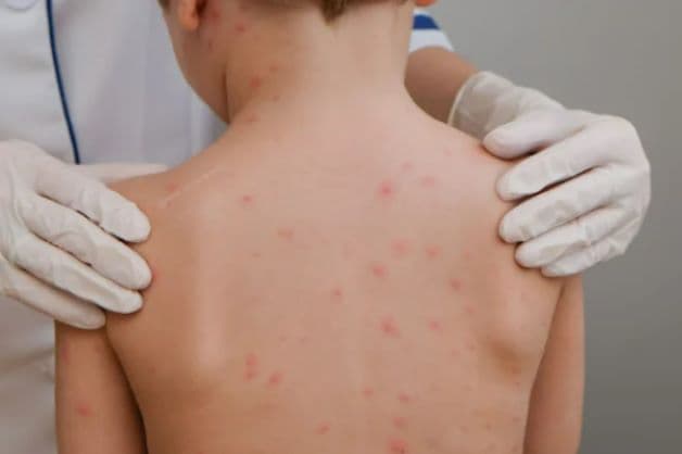 Mụn thủy đậu xuất hiện từ giai đoạn toàn phát