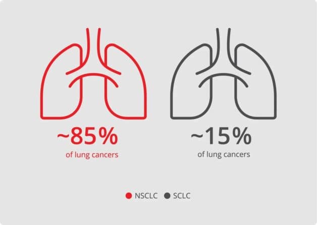 Kế hoạch và phương án điều trị ung thư phổi NSCLC và SCLC