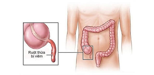 Nhận biết các triệu chứng của bệnh đau ruột thừa