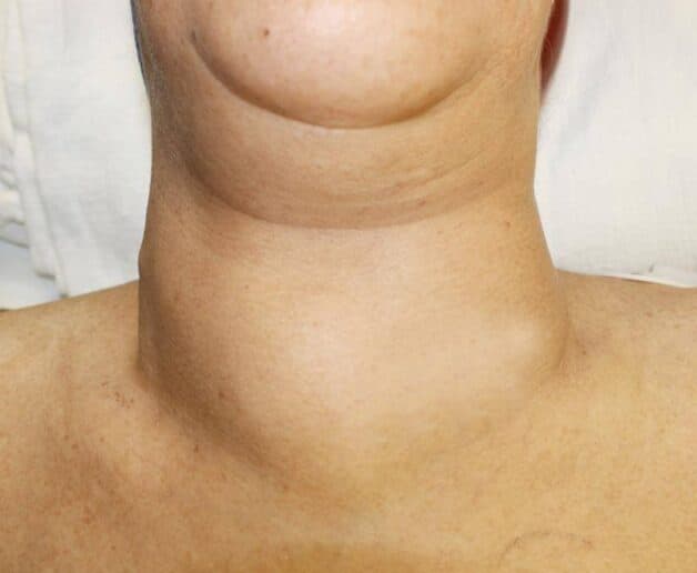 Hình ảnh tuyến giáp phì đại