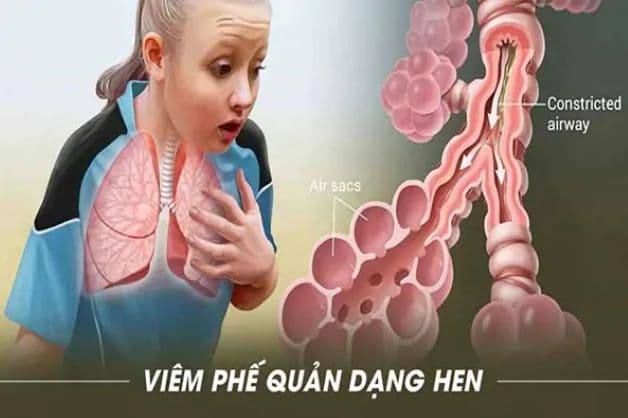Dấu hiệu nhận biết trẻ có thể đã bị viêm phế quản dạng hen