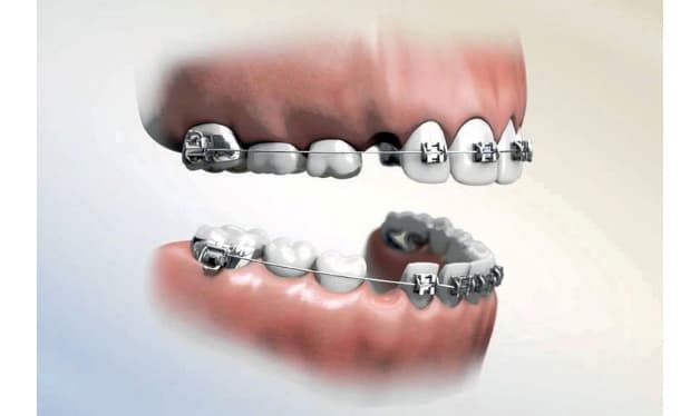 bảng giá nắn chỉnh răng